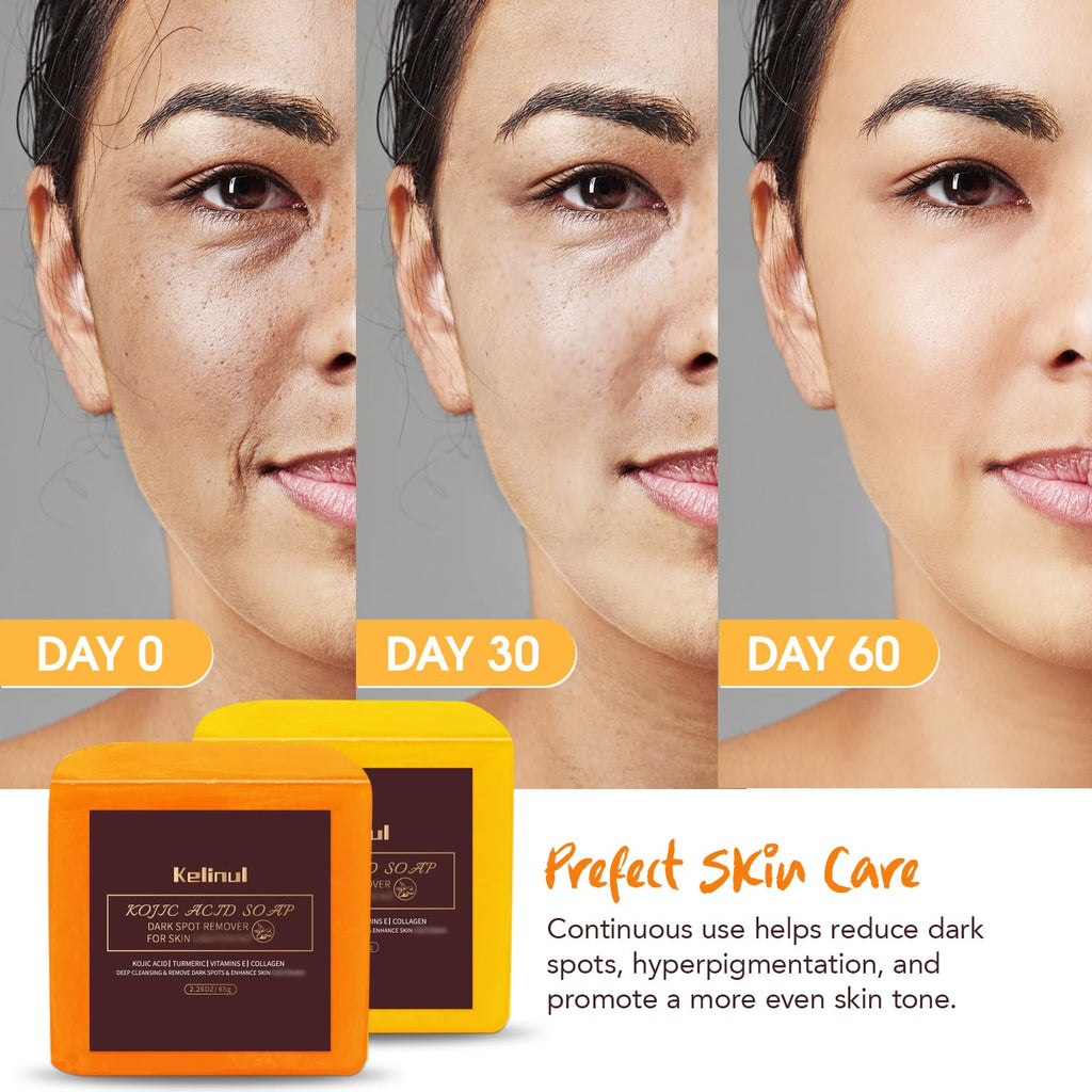 Kojic Acid Soap Bars for Dark Spots, Face and Body, 9 oz, 4 Count S674