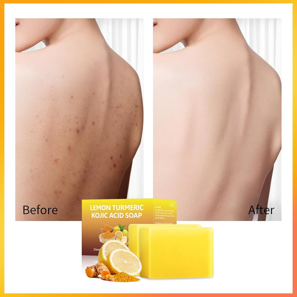 Lemon Turmeric Kojic Acid Soap Bar for Dark Spots and Hyperpigmentation, 2 Pack V9557